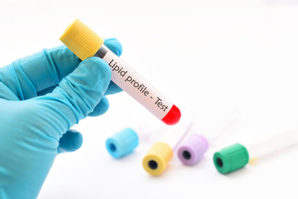 Lipid Profile